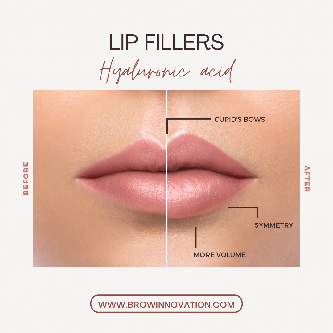 Lip Fillers Service (1 Syringe) RHA Brow Innovation