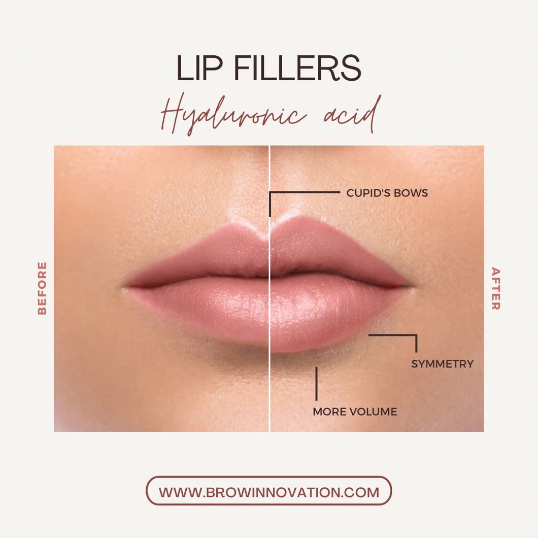 Lip Fillers Service (1 Syringe) RHA