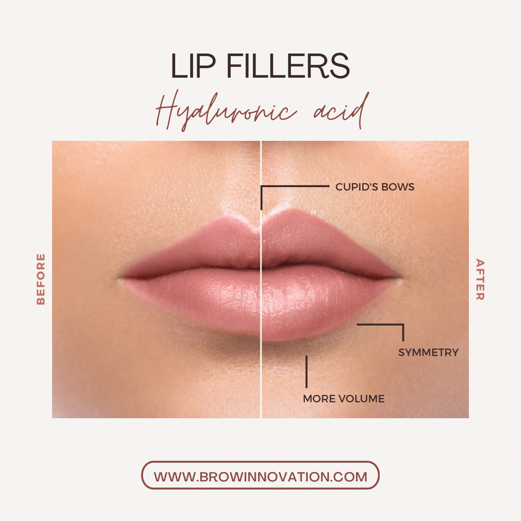 Lip Fillers Service (1/2 Syringe) RHA