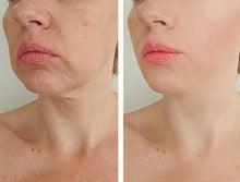 Load image into Gallery viewer, Microneedling Service
